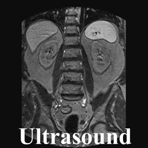 Ultrasound Image of Adrenal Glands